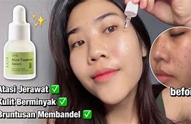 Serum Untuk Kulit Berjerawat